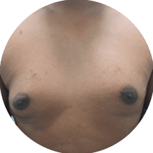 Gynecomastia Surgery