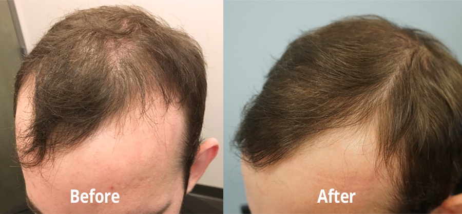 PRP-Results-Before-After