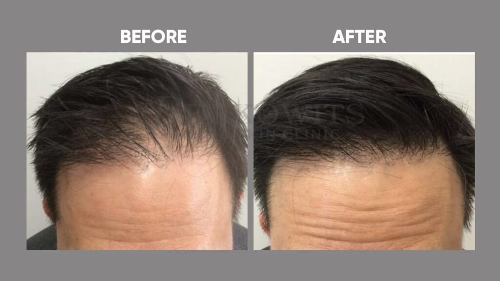 PRP-before-after-image-3