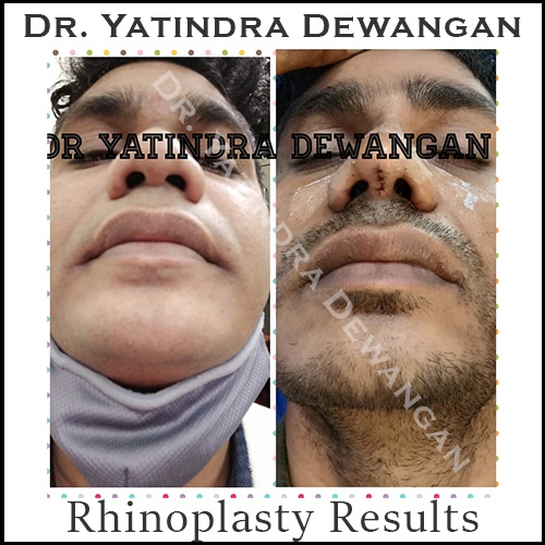 Rhinoplasty Results 1