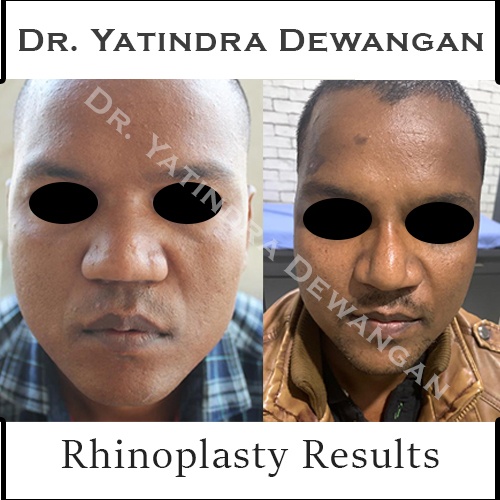 Rhinoplasty Results 2