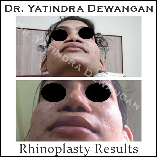 Rhinoplasty Results 3