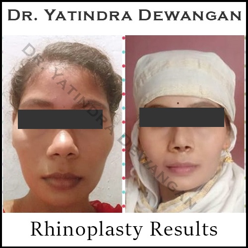 Rhinoplasty Results
