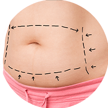 Tummy Tuck Surgery