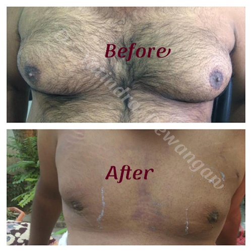 DrY Gynecomastia After & Before 1