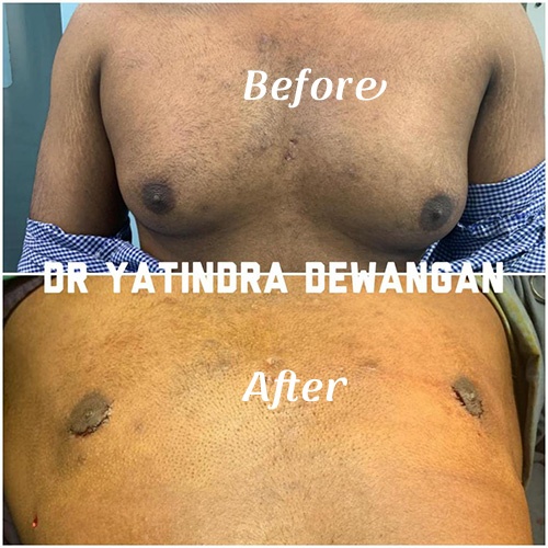 DrY Gynecomastia After & Before 2