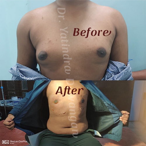 DrY Gynecomastia After & Before 3