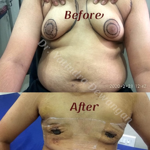 DrY Gynecomastia After & Before 4