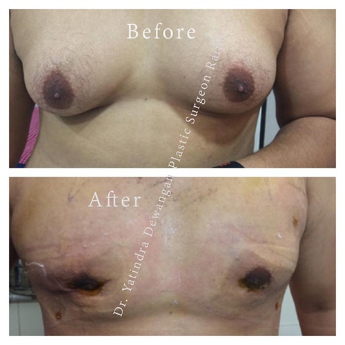 DrY Gynecomastia After & Before 5