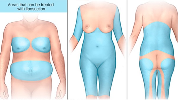 Liposuction Surgery Raipur CG