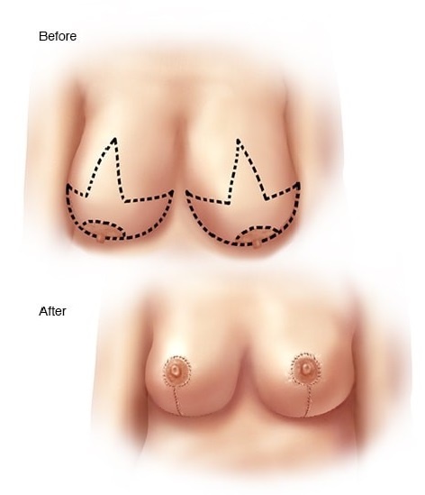 Female Breast Reduction Surgery