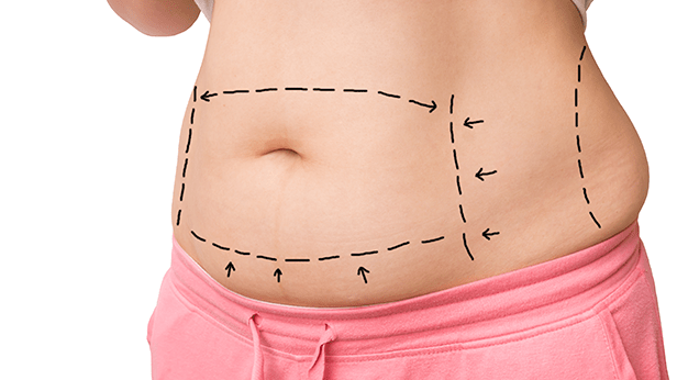 Tummy Tuck Surgery Or Abdominoplasty