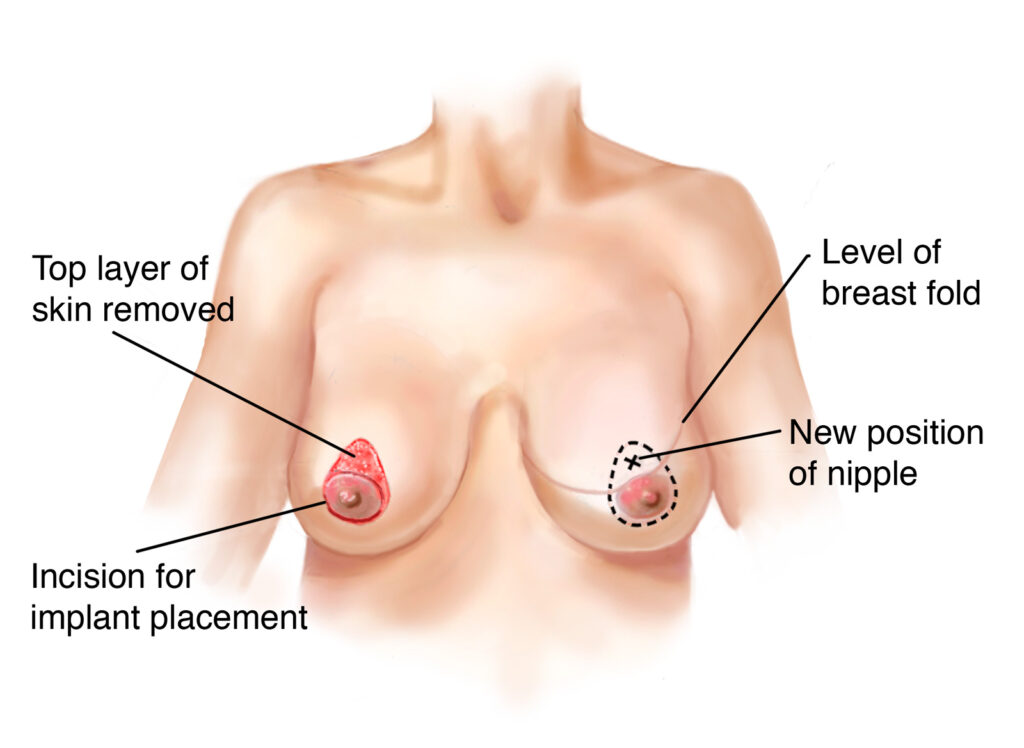Nipple Reconstruction Surgery In Raipur By Dr. Yatindra Dewangan, Breast