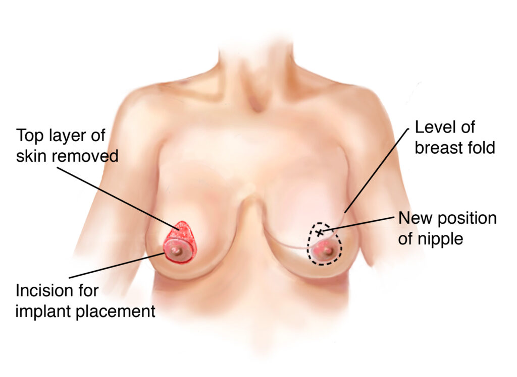 Nipple Reconstruction Surgery