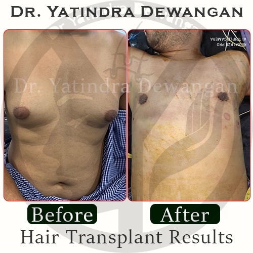 https://www.drycosmetoplastic.com/wp-content/uploads/2021/10/Gynecomastia-Results.jpg