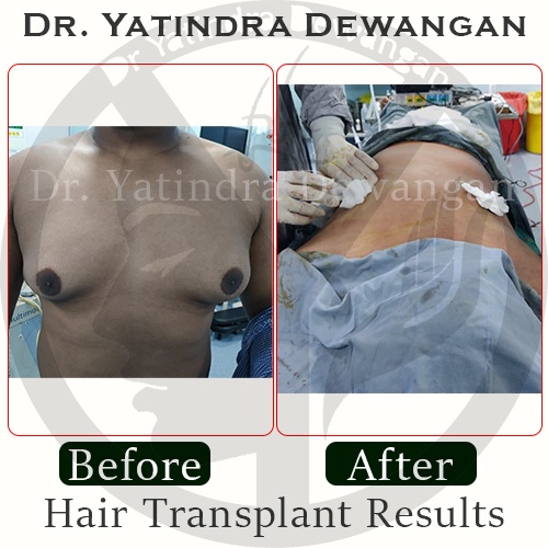 Gynecomastia Results2