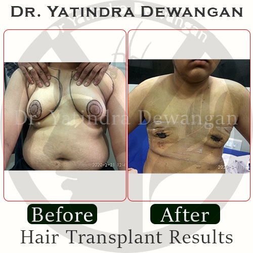 Gynecomastia Results3