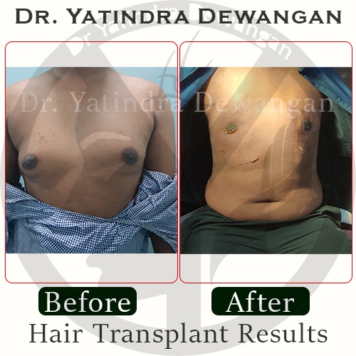 Gynecomastia Results4