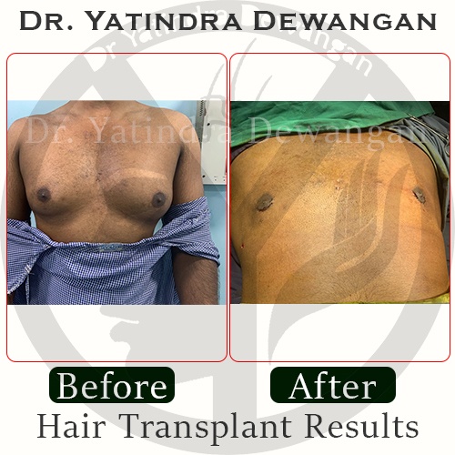 Gynecomastia Results5