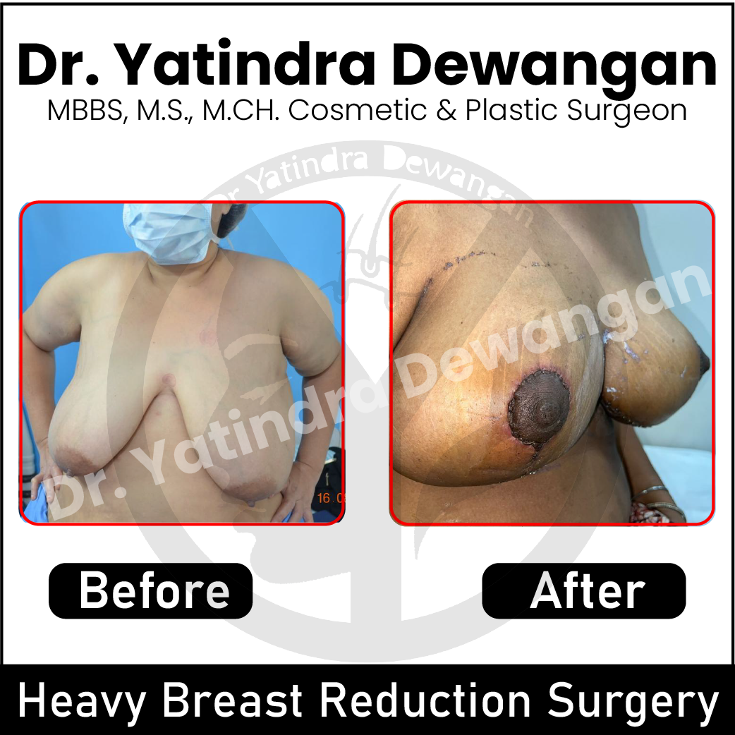 https://www.drycosmetoplastic.com/wp-content/uploads/2023/06/Heavy-Breast-Reduction-By-Dr.-Yatindra-Dewangan-Raipur-01.png