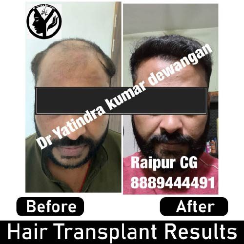 Hair Transplant Results-01-01