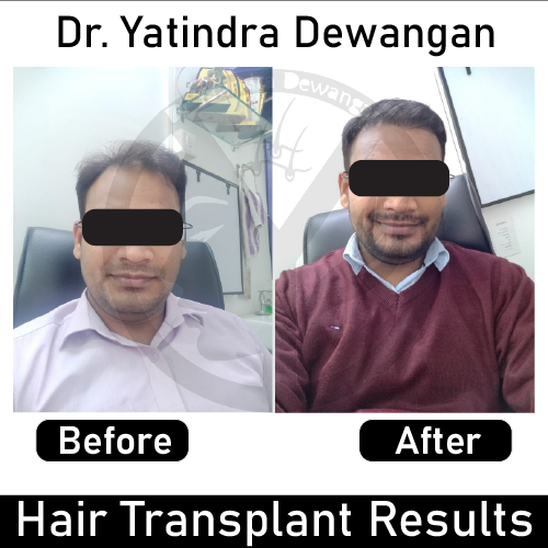 Hair Transplant Results-02-01-01