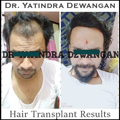 Hair Transplant Results 2.