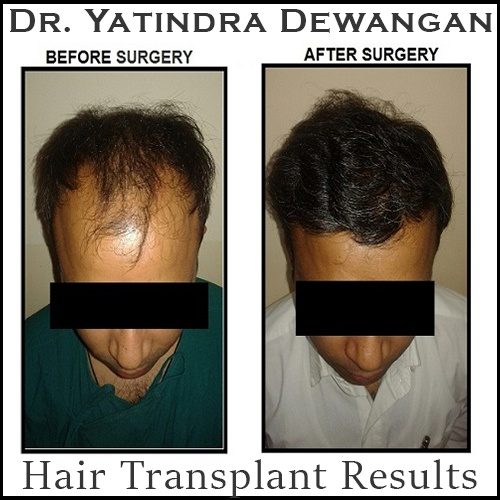 Hair Transplant Results 3