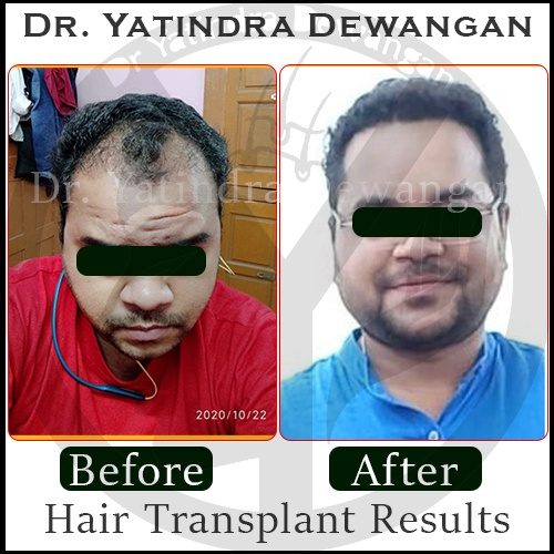 Hair Transplant Results New