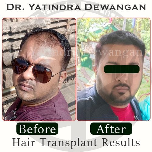 Hair Transplant Results New1