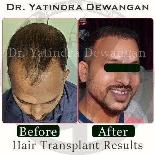 Hair Transplant Results New2