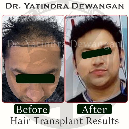 Hair Transplant Results New3