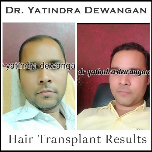 Hair Transplant Results.