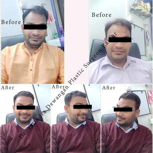 Hair Transplant In Raipur By Dr. Yatindra Dewangan, Hair Transplant Clinic