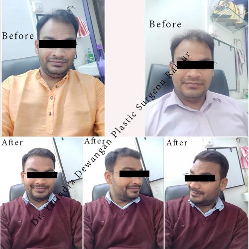 Hair Transplant In Raipur By Dr. Yatindra Dewangan, Hair Transplant Clinic Hair Transplant In Raipur By Dr. Yatindra Dewangan, Hair Transplant Clinic